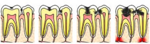 Fases de la caries dental