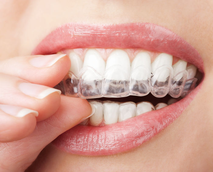 funcionamiento ortodoncia invisalign