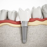 El implante dental: ¿qué debes saber?