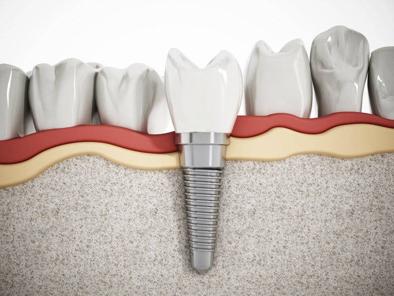El implante dental: ¿qué debes saber?
