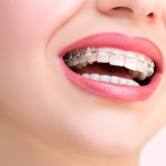 ¿ Qué puedo comer con ortodoncia?