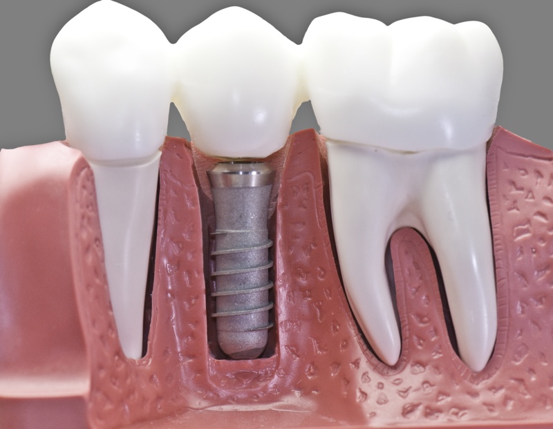 Implantes dentales en Barcelona