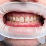 ¿Que es la fluorosis dental?