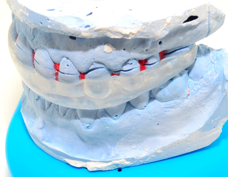 Esta es la manera adecuada de limpiar y desinfectar tu férula dental según  los dentistas
