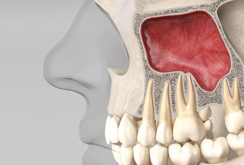 Elevación de seno maxilar: ¿en qué consiste?