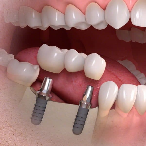 Beneficios de los implantes de carga inmediata