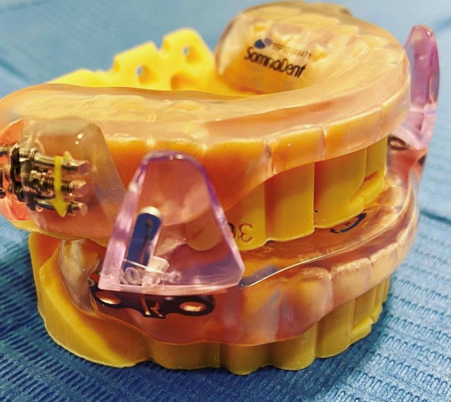 Férula de avance mandibular, en Clínica Dental Galindo