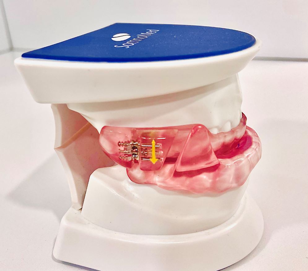 Dispositivo oral para tratar la apnea del sueño