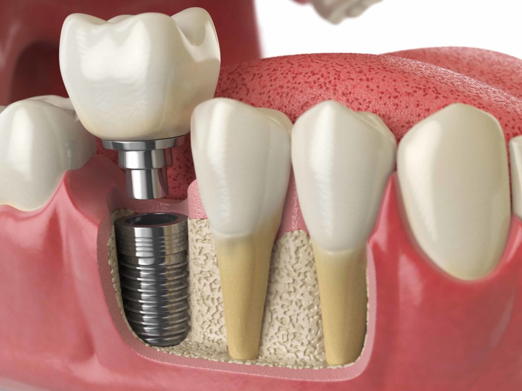 La cirugía para los implantes dentales es poco invasiva