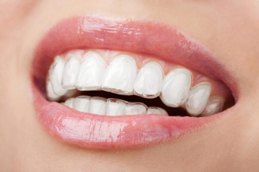 Los alineadores invisibles corrigen el mal alineamiento de los dientes
