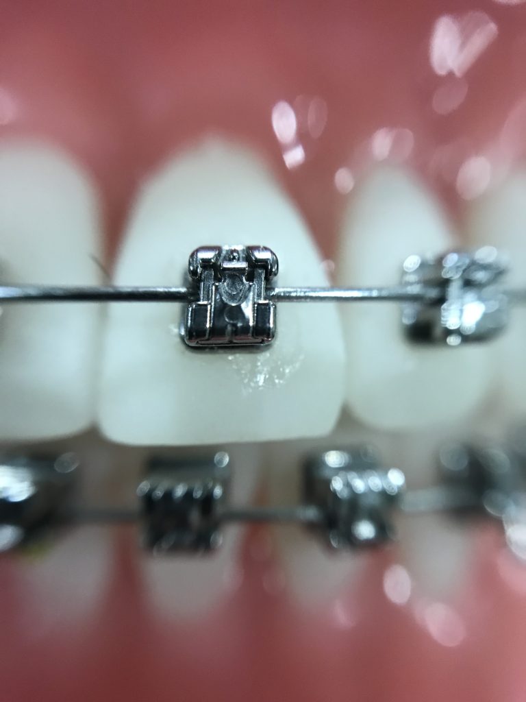 Ortodoncia y aftas bucales
