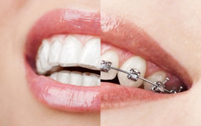 Invisalign vs brackets: ¿qué ortodoncia elegir?