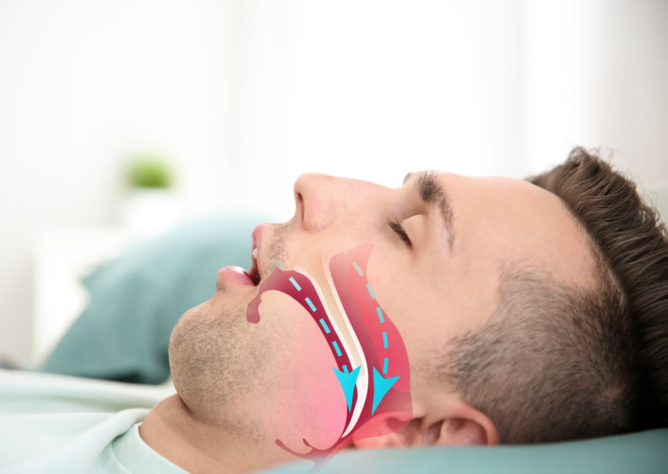 RoncoApnea - ➡️ DAM: Dispositivo de Avance Mandibular