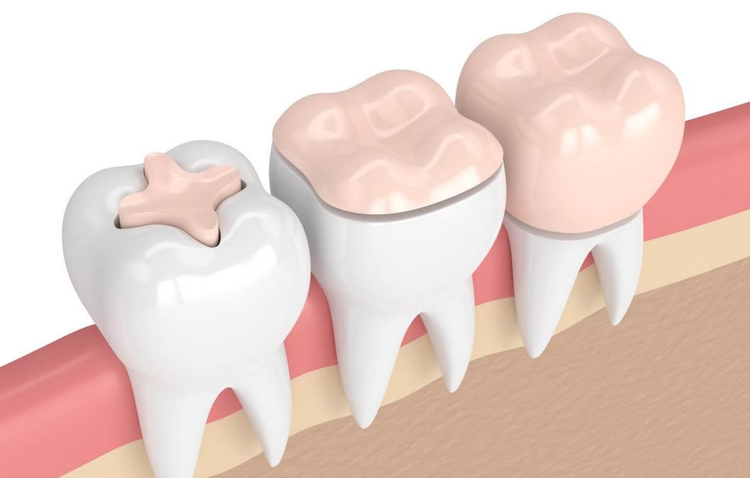 ¿Qué es una incrustación dental?