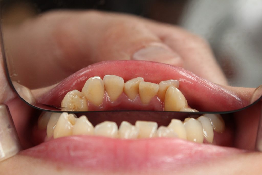 Apiñamiento dental