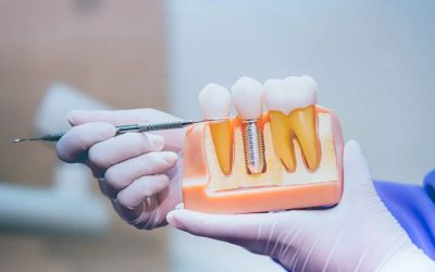 Implantes dentales Barcelona: guía completa para recuperar tu sonrisa en 2025