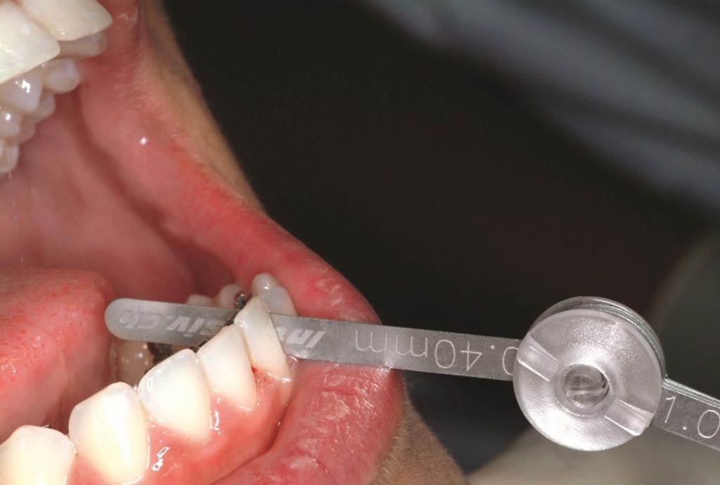 Galgas dentales para medir la reducción interproximal Galgas dentales para medir la reducción interproximal
